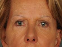 Eyelid Surgery After Photo by Ellen Janetzke, MD; Bloomfield Hills, MI - Case 28059