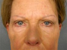 Eyelid Surgery Before Photo by Ellen Janetzke, MD; Bloomfield Hills, MI - Case 28059