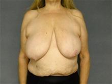 Breast Reduction Before Photo by Ellen Janetzke, MD; Bloomfield Hills, MI - Case 28118