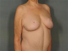 Breast Reduction After Photo by Ellen Janetzke, MD; Bloomfield Hills, MI - Case 28118