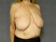 Breast Reduction Before Photo by Ellen Janetzke, MD; Bloomfield Hills, MI - Case 28118