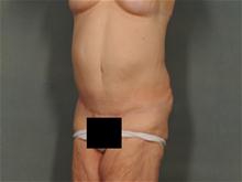 Body Contouring After Photo by Ellen Janetzke, MD; Bloomfield Hills, MI - Case 28120
