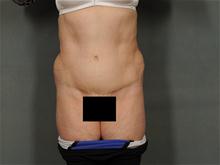 Tummy Tuck After Photo by Ellen Janetzke, MD; Bloomfield Hills, MI - Case 28121