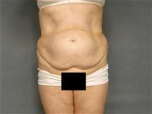 Tummy Tuck Before Photo by Ellen Janetzke, MD; Bloomfield Hills, MI - Case 28121