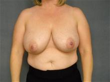 Breast Reduction Before Photo by Ellen Janetzke, MD; Bloomfield Hills, MI - Case 28498