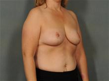 Breast Reduction After Photo by Ellen Janetzke, MD; Bloomfield Hills, MI - Case 28498