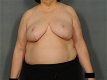 Breast Reduction After Photo by Ellen Janetzke, MD; Bloomfield Hills, MI - Case 28499