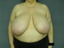 Breast Reduction Before Photo by Ellen Janetzke, MD; Bloomfield Hills, MI - Case 28499