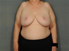 Breast Reduction After Photo by Ellen Janetzke, MD; Bloomfield Hills, MI - Case 28500