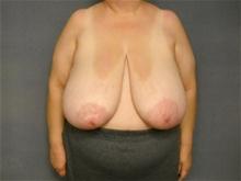 Breast Reduction Before Photo by Ellen Janetzke, MD; Bloomfield Hills, MI - Case 28500