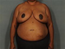 Breast Reduction After Photo by Ellen Janetzke, MD; Bloomfield Hills, MI - Case 28501