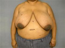 Breast Reduction Before Photo by Ellen Janetzke, MD; Bloomfield Hills, MI - Case 28501