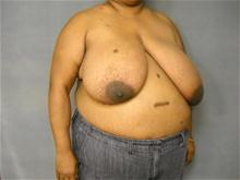 Breast Reduction Before Photo by Ellen Janetzke, MD; Bloomfield Hills, MI - Case 28501
