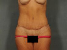 Tummy Tuck After Photo by Ellen Janetzke, MD; Bloomfield Hills, MI - Case 28502