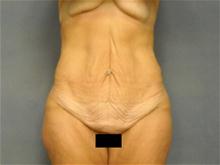 Tummy Tuck Before Photo by Ellen Janetzke, MD; Bloomfield Hills, MI - Case 28502