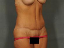 Tummy Tuck After Photo by Ellen Janetzke, MD; Bloomfield Hills, MI - Case 28502
