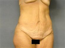 Tummy Tuck Before Photo by Ellen Janetzke, MD; Bloomfield Hills, MI - Case 28502
