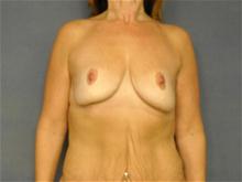 Breast Augmentation Before Photo by Ellen Janetzke, MD; Bloomfield Hills, MI - Case 28503