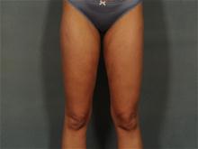 Liposuction After Photo by Ellen Janetzke, MD; Bloomfield Hills, MI - Case 28507