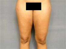Liposuction Before Photo by Ellen Janetzke, MD; Bloomfield Hills, MI - Case 28507