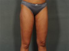 Liposuction After Photo by Ellen Janetzke, MD; Bloomfield Hills, MI - Case 28507