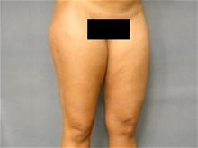 Liposuction Before Photo by Ellen Janetzke, MD; Bloomfield Hills, MI - Case 28507