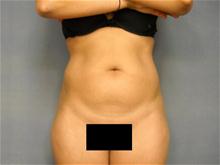 Liposuction Before Photo by Ellen Janetzke, MD; Bloomfield Hills, MI - Case 28508