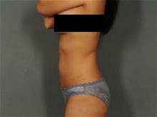 Liposuction After Photo by Ellen Janetzke, MD; Bloomfield Hills, MI - Case 28508