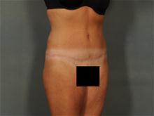 Tummy Tuck After Photo by Ellen Janetzke, MD; Bloomfield Hills, MI - Case 28527