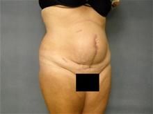 Tummy Tuck Before Photo by Ellen Janetzke, MD; Bloomfield Hills, MI - Case 28527