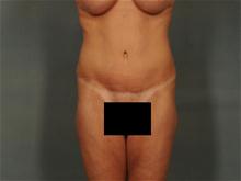 Tummy Tuck After Photo by Ellen Janetzke, MD; Bloomfield Hills, MI - Case 28673