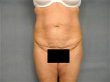 Tummy Tuck Before Photo by Ellen Janetzke, MD; Bloomfield Hills, MI - Case 28673