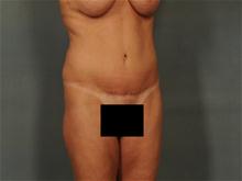 Tummy Tuck After Photo by Ellen Janetzke, MD; Bloomfield Hills, MI - Case 28673