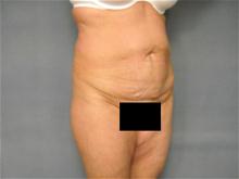 Tummy Tuck Before Photo by Ellen Janetzke, MD; Bloomfield Hills, MI - Case 28673