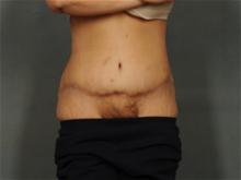 Tummy Tuck After Photo by Ellen Janetzke, MD; Bloomfield Hills, MI - Case 28679