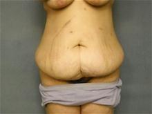 Tummy Tuck Before Photo by Ellen Janetzke, MD; Bloomfield Hills, MI - Case 28679