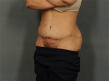 Tummy Tuck After Photo by Ellen Janetzke, MD; Bloomfield Hills, MI - Case 28679