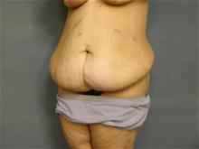 Tummy Tuck Before Photo by Ellen Janetzke, MD; Bloomfield Hills, MI - Case 28679