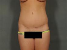 Tummy Tuck After Photo by Ellen Janetzke, MD; Bloomfield Hills, MI - Case 28712
