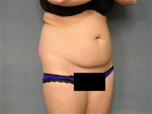 Tummy Tuck Before Photo by Ellen Janetzke, MD; Bloomfield Hills, MI - Case 28712