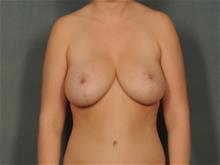 Breast Lift After Photo by Ellen Janetzke, MD; Bloomfield Hills, MI - Case 28713