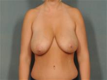 Breast Lift Before Photo by Ellen Janetzke, MD; Bloomfield Hills, MI - Case 28713