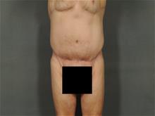 Tummy Tuck After Photo by Ellen Janetzke, MD; Bloomfield Hills, MI - Case 28714