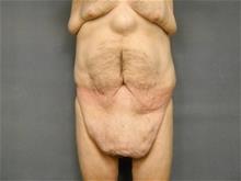 Tummy Tuck Before Photo by Ellen Janetzke, MD; Bloomfield Hills, MI - Case 28714