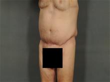 Tummy Tuck After Photo by Ellen Janetzke, MD; Bloomfield Hills, MI - Case 28714