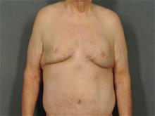 Male Breast Reduction After Photo by Ellen Janetzke, MD; Bloomfield Hills, MI - Case 28715