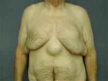 Male Breast Reduction Before Photo by Ellen Janetzke, MD; Bloomfield Hills, MI - Case 28715