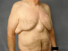 Male Breast Reduction Before Photo by Ellen Janetzke, MD; Bloomfield Hills, MI - Case 28715