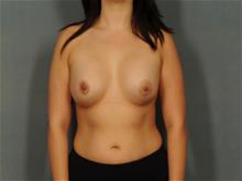 Breast Augmentation After Photo by Ellen Janetzke, MD; Bloomfield Hills, MI - Case 28759