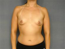 Breast Augmentation Before Photo by Ellen Janetzke, MD; Bloomfield Hills, MI - Case 28759